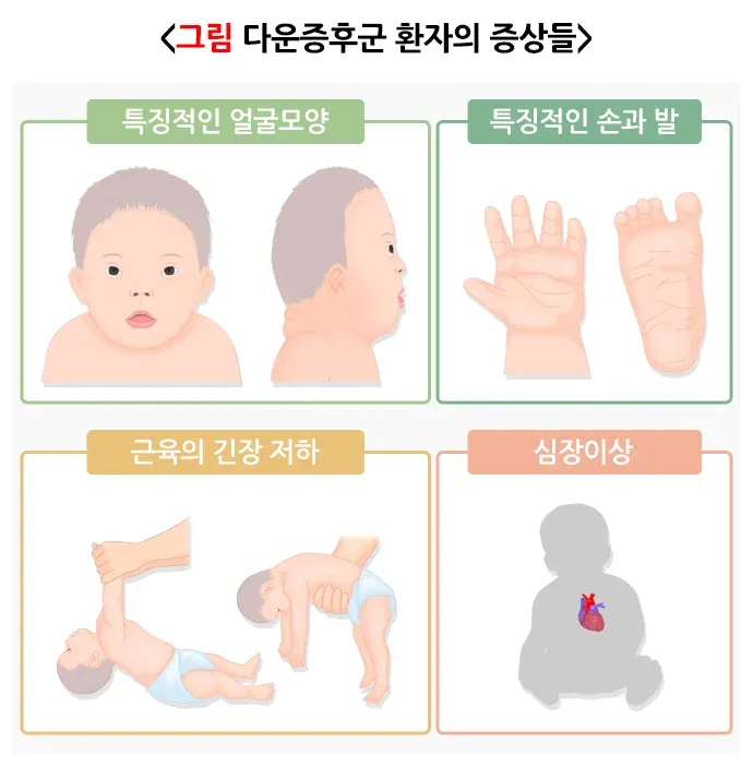 다운증후군 증상 설명 이미지 1