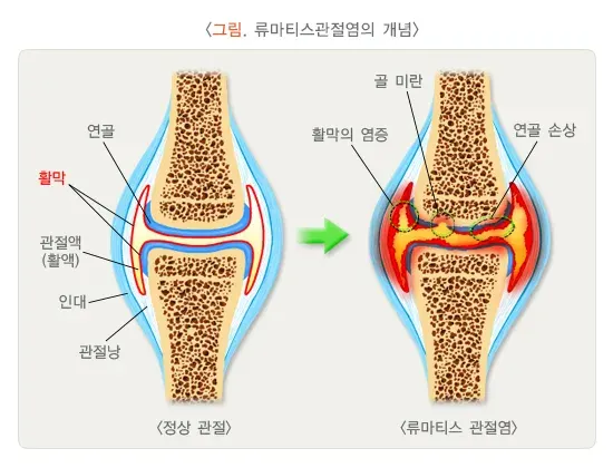 류마티스관절염 병태생리 설명 이미지 1