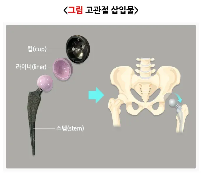 고관절 전치환술 치료 방법 설명 이미지 1