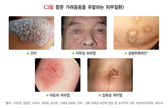 항문 가려움증 원인 설명 이미지 2