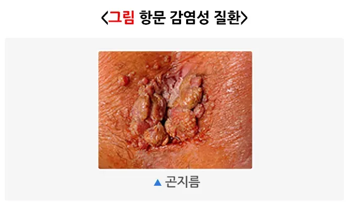 항문 가려움증 원인 설명 이미지 4
