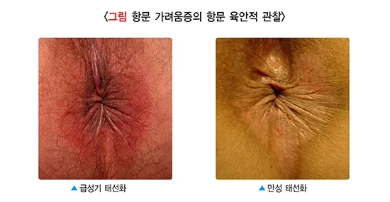 항문 가려움증 진단 및 검사 설명 이미지 1