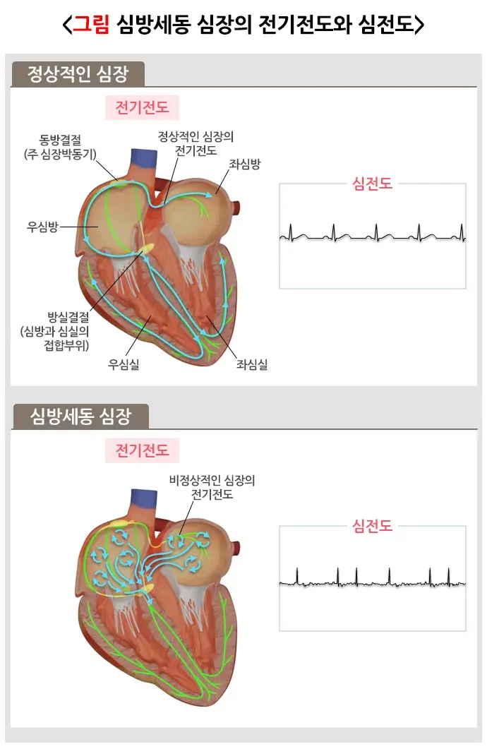 항응고요법 치료 방법 설명 이미지 1