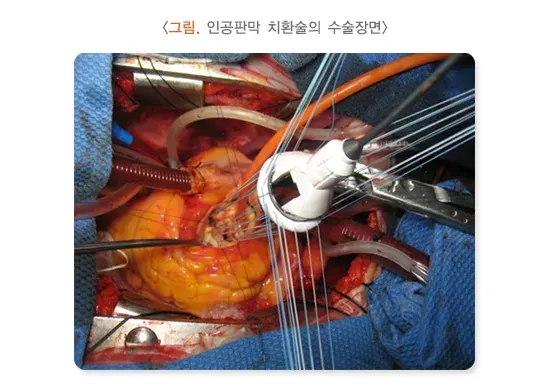항응고요법 치료 방법 설명 이미지 3
