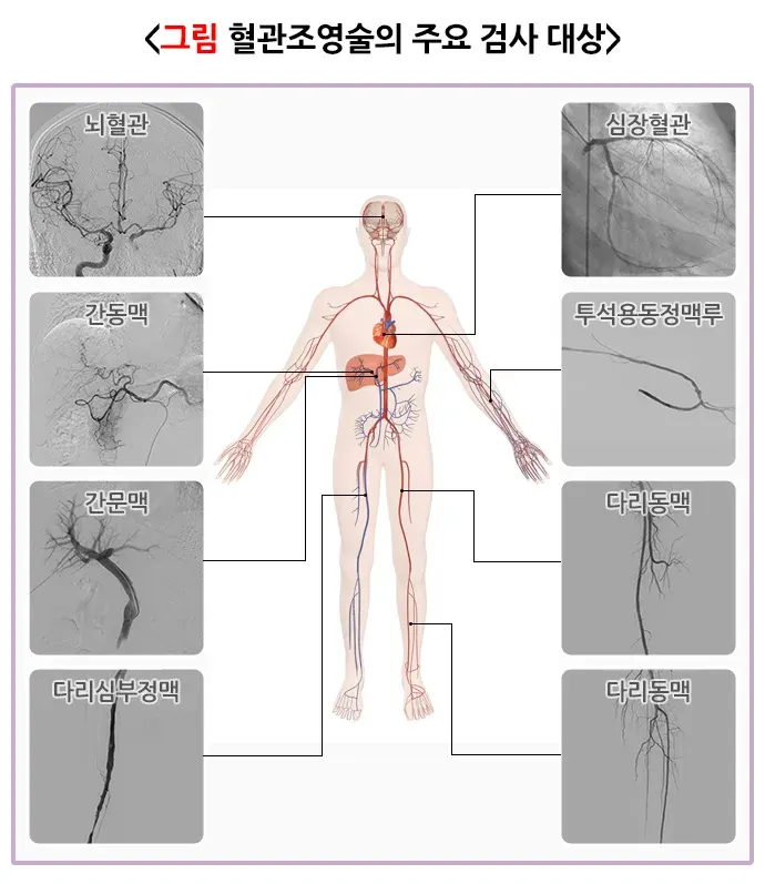 혈관조영술 검사 목적 설명 이미지 1
