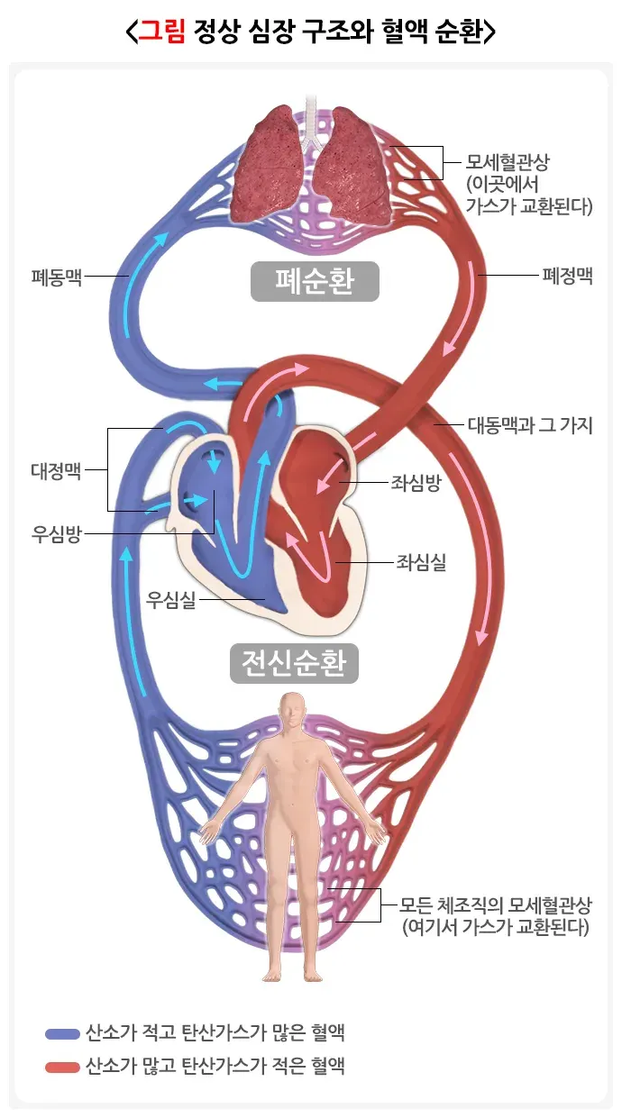 동맥관 개존증 병태생리 설명 이미지 1