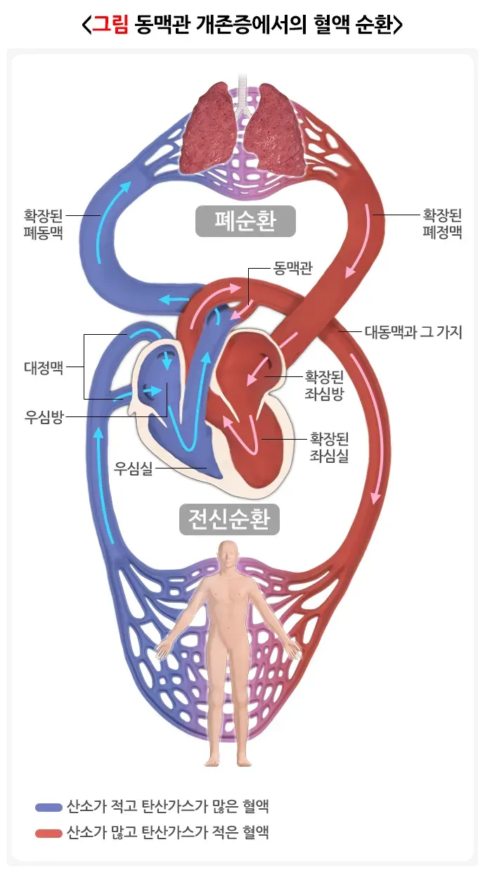 동맥관 개존증 병태생리 설명 이미지 2