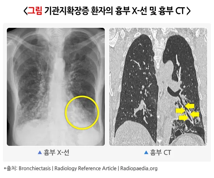 기관지확장증 진단 및 검사 설명 이미지 1