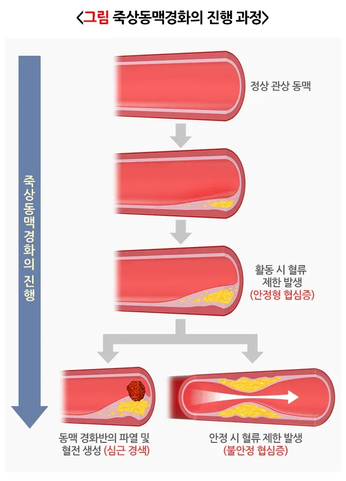 협심증 원인 설명 이미지 2