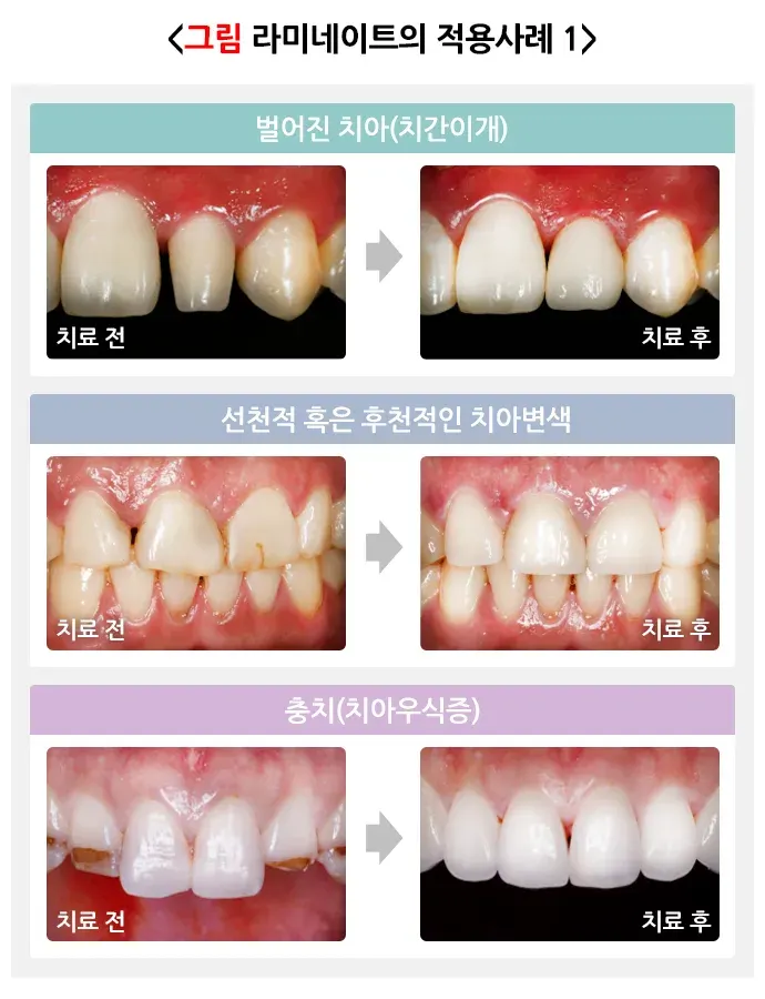 라미네이트 치료 치료의 적응증 설명 이미지 1