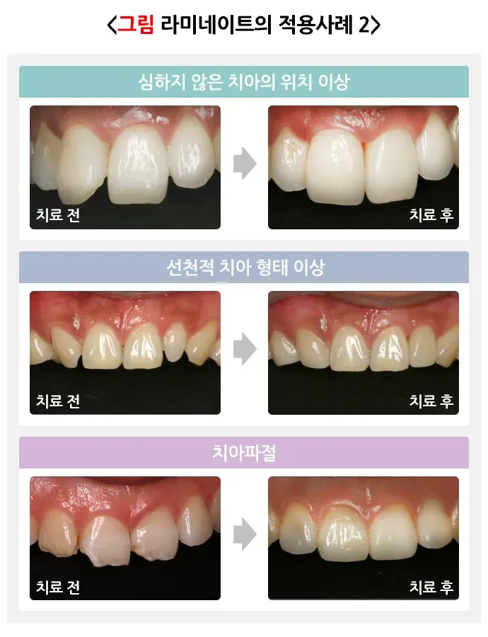 라미네이트 치료 치료의 적응증 설명 이미지 2