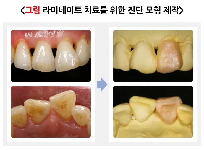 라미네이트 치료 치료 방법 설명 이미지 1