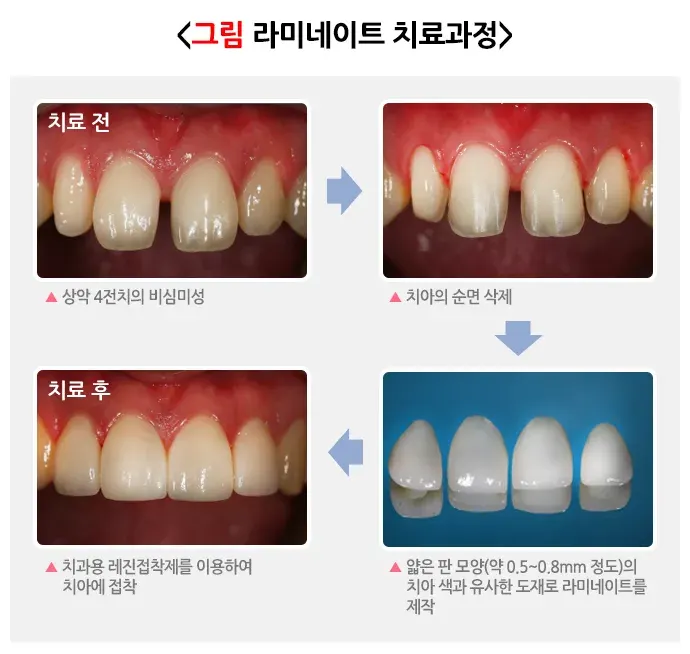 라미네이트 치료 치료 방법 설명 이미지 2