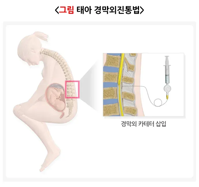 자연분만과정 치료 설명 이미지 1