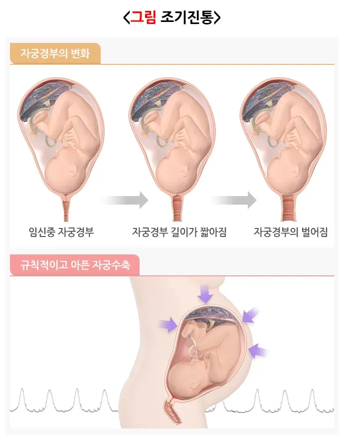 조산 진단 및 검사 설명 이미지 1