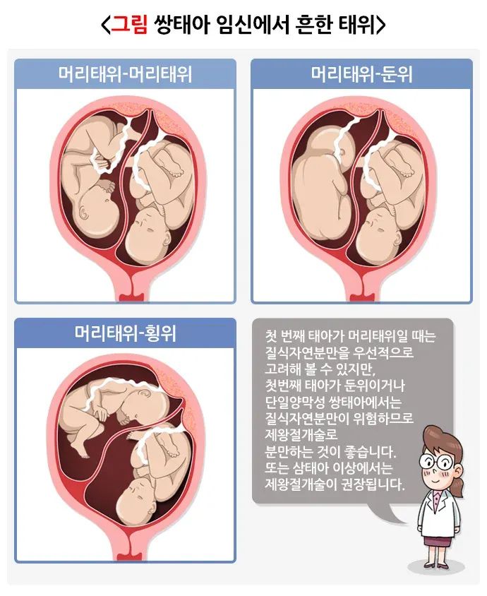 다태임신 치료 설명 이미지 1