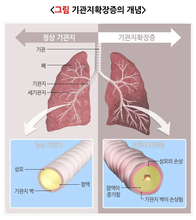 기관지확장증 정의 설명 이미지 1
