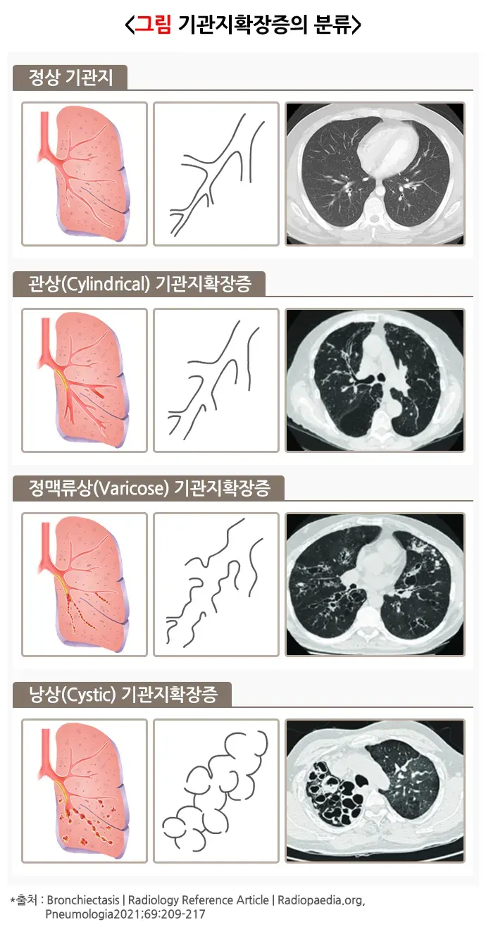 기관지확장증 종류 설명 이미지 1