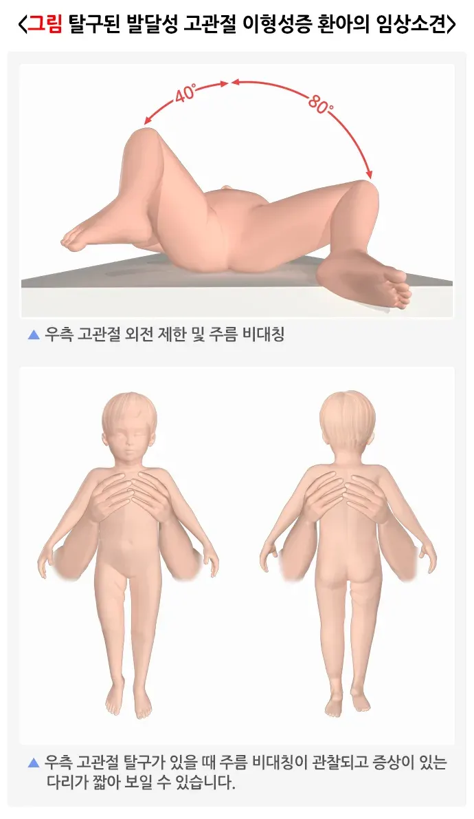 발달성 고관절 이형성증 및 탈구 증상 설명 이미지 1