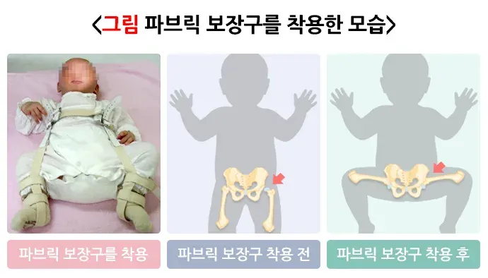 발달성 고관절 이형성증 및 탈구 치료 설명 이미지 1