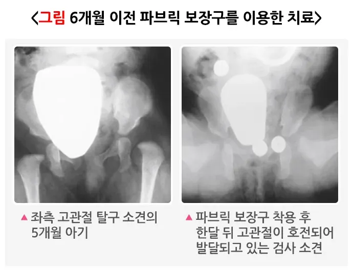 발달성 고관절 이형성증 및 탈구 치료 설명 이미지 2