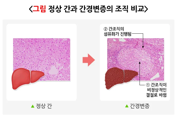 간경변증 병태생리 설명 이미지 1