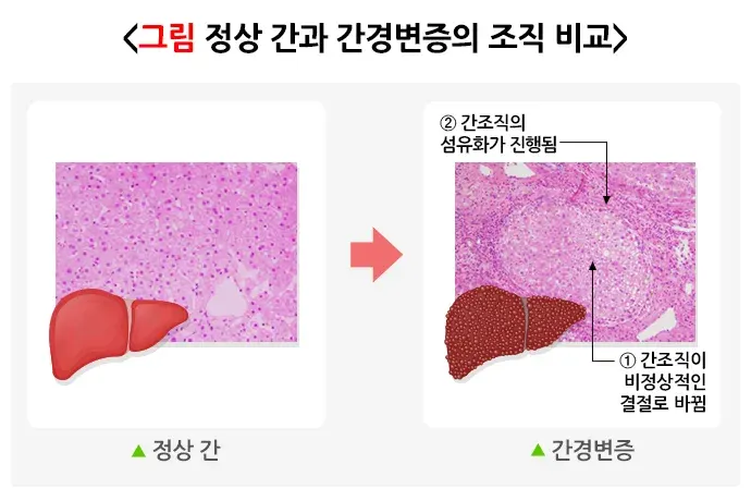 간경변증 병태생리 설명 이미지 1