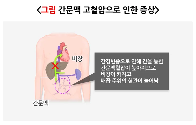간경변증 병태생리 설명 이미지 2