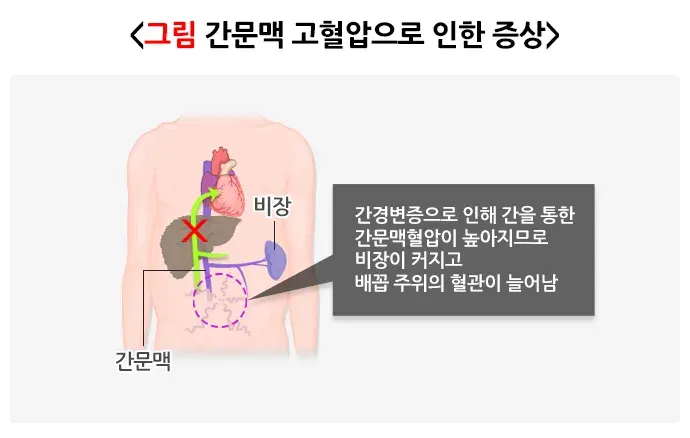간경변증 병태생리 설명 이미지 2