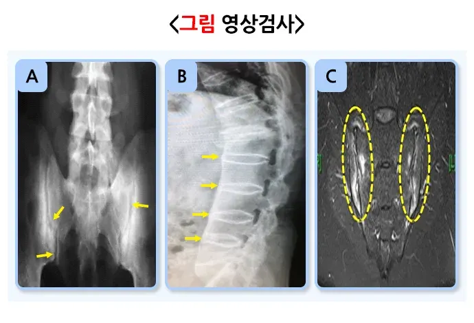 강직척추염 진단 및 검사 설명 이미지 2
