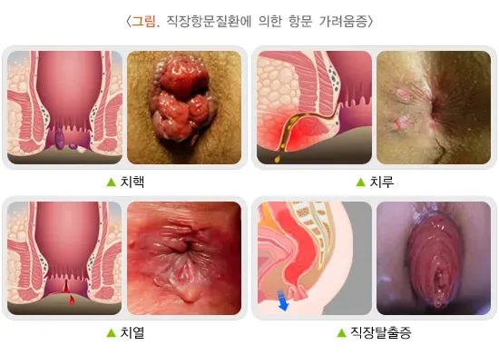항문 가려움증 원인 설명 이미지 1
