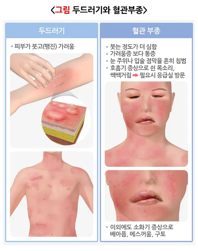 두드러기 증상 설명 이미지 1