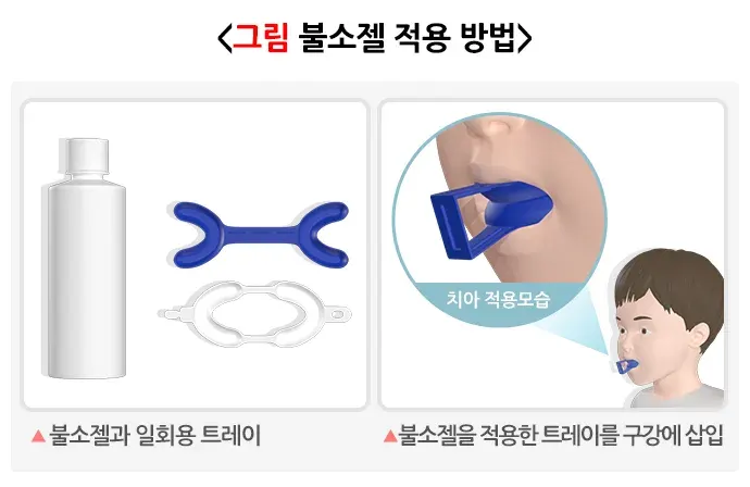 불소도포 일반적 실천 방법 설명 이미지 1