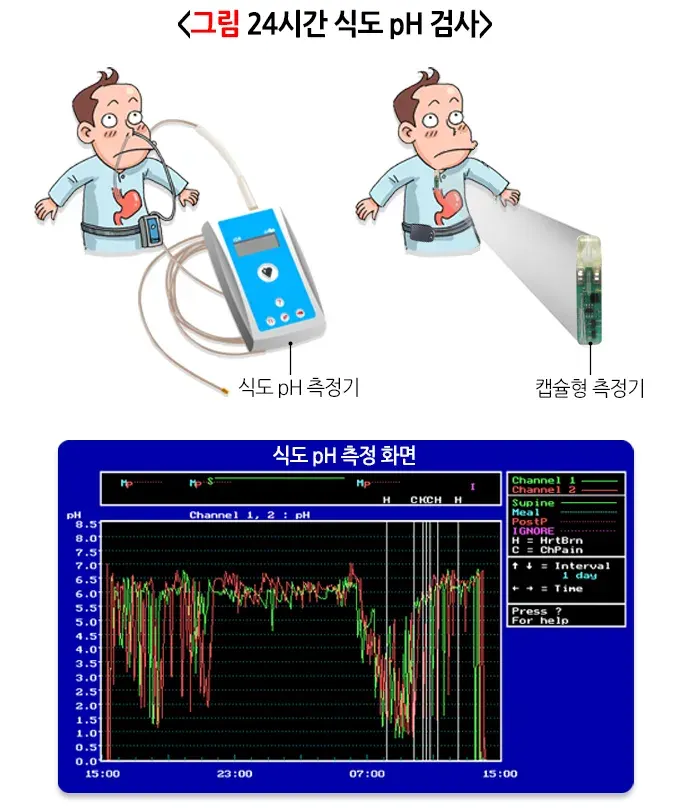 위식도역류질환 진단 및 검사 설명 이미지 2
