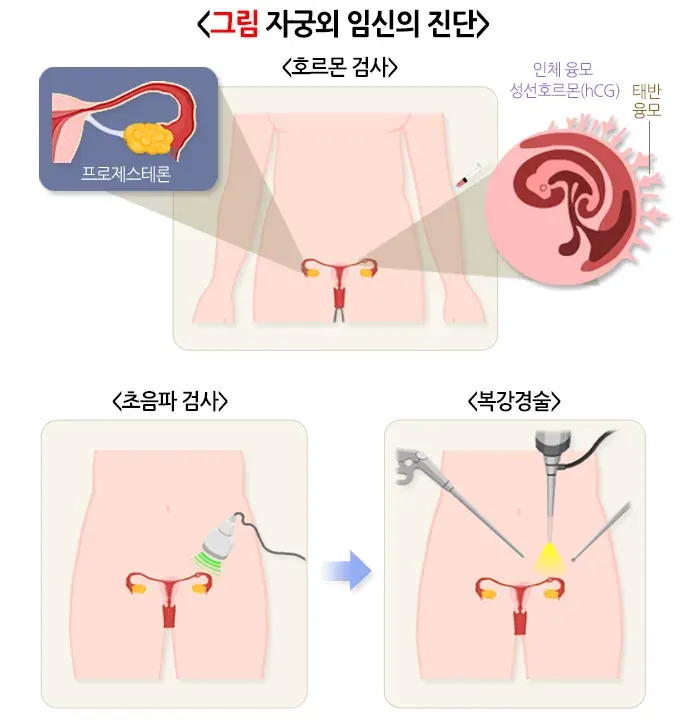자궁외 임신 진단 및 검사 설명 이미지 1