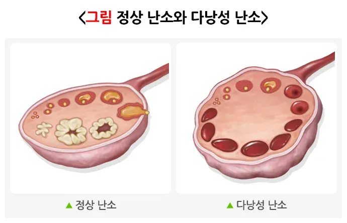 다낭성난소증후군 정의 설명 이미지 1