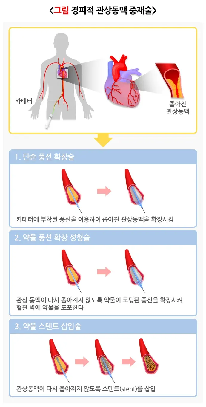 협심증 비약물 치료 설명 이미지 1