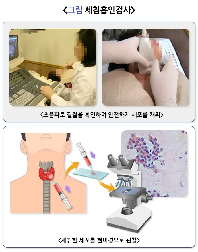 갑상선 결절 진단 및 검사 설명 이미지 1