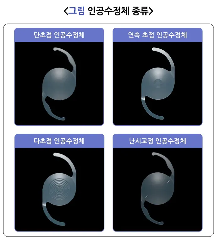 백내장 치료 설명 이미지 4