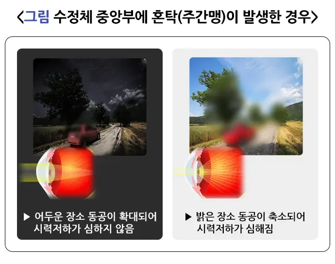 백내장 증상 설명 이미지 2
