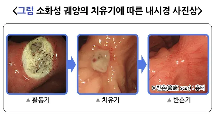 위십이지장 궤양 진단 및 검사 설명 이미지 1