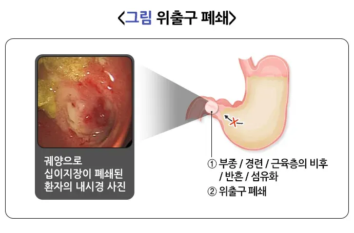 위십이지장 궤양 합병증 설명 이미지 4