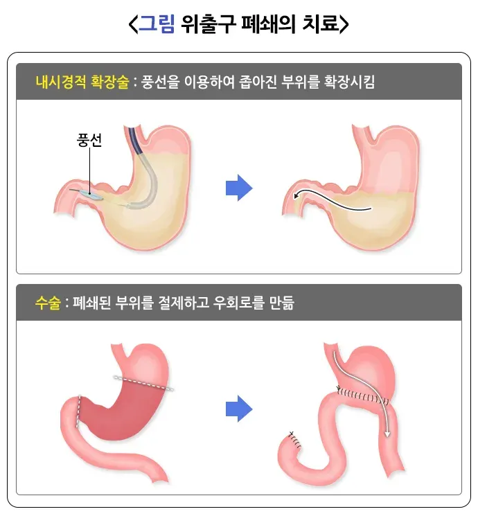 위십이지장 궤양 합병증 설명 이미지 5