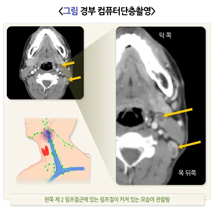 경부 종괴 진단 및 검사 설명 이미지 2