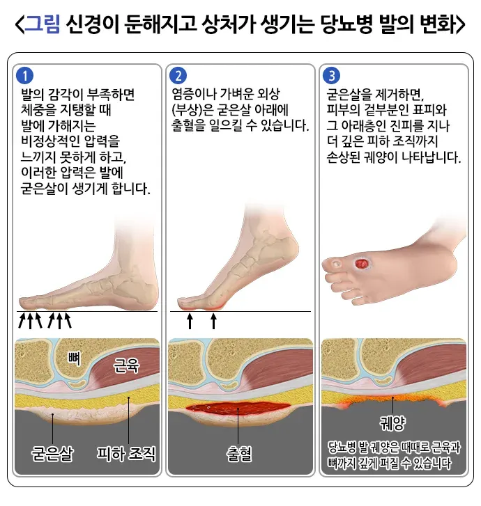 당뇨병성 족부병증 병태생리 설명 이미지 1