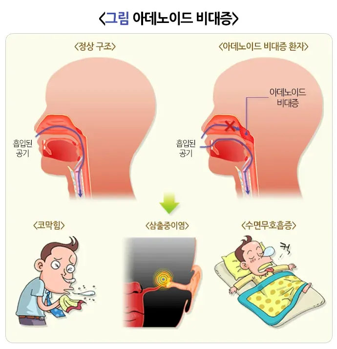 편도염 원인 설명 이미지 1