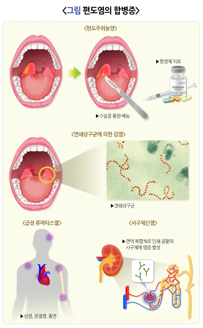 편도염 합병증 설명 이미지 1