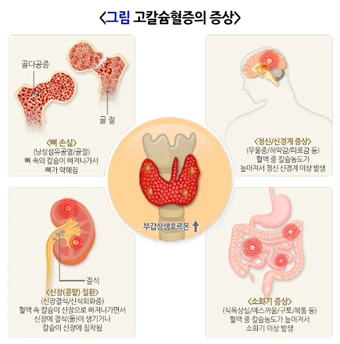 고칼슘혈증 증상 설명 이미지 1