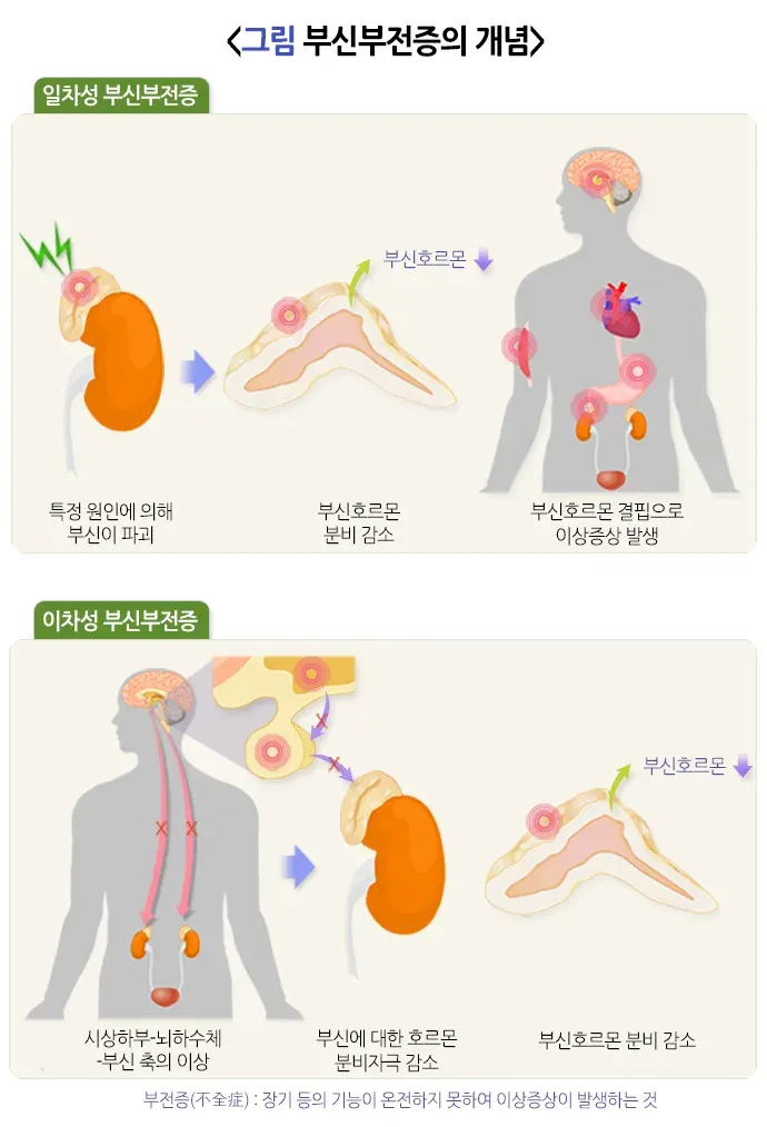 부신부전증 종류 설명 이미지 1