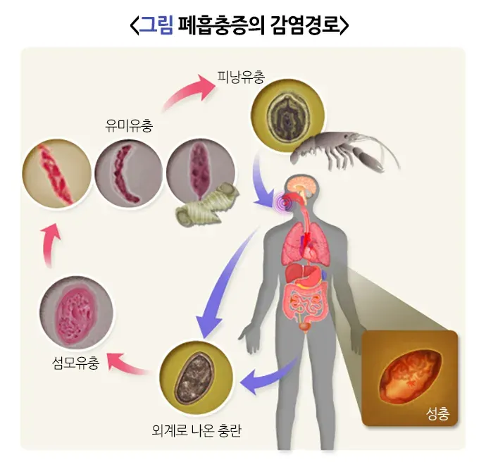 폐흡충증 원인 및 감염경로 설명 이미지 1